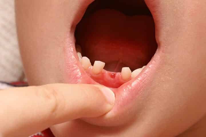 Kind tanden wisselen