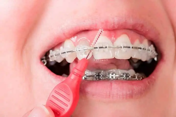 verzorging tanden met beugel